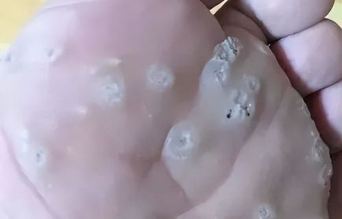 身上出现的小疙瘩，警惕HPV感染的五大信号