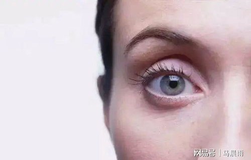 警惕青光眼，眼睛出现三种情况需谨慎