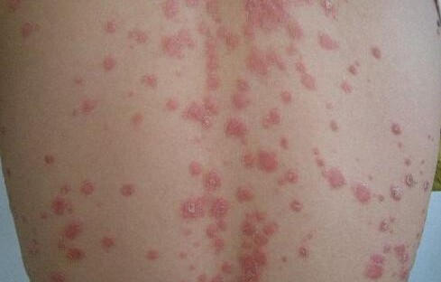 杭州实现重大突破，红斑狼疮治疗新篇章的开启