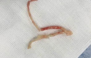 男童高烧不退，全家竟感染肝吸虫——警惕生活细节中的健康隐患