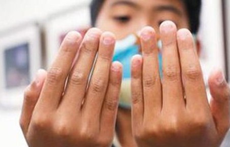 反复啃咬指甲，一种心理障碍的探索