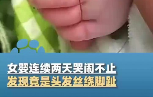 女婴两天哭闹不止，头发丝绕脚趾的意外发现