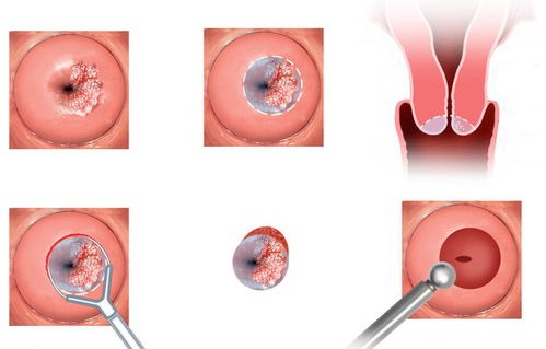 从HPV感染到宫颈癌，五步之遥的警示