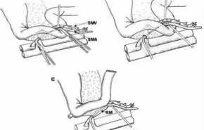 inferior（inferior mesenteric artery）