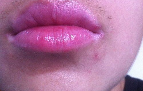 嘴角起泡，一种常见的病毒感染现象