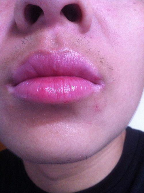 嘴角起泡，一种常见的病毒感染现象