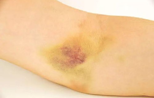 揭秘身体莫名淤青的背后原因