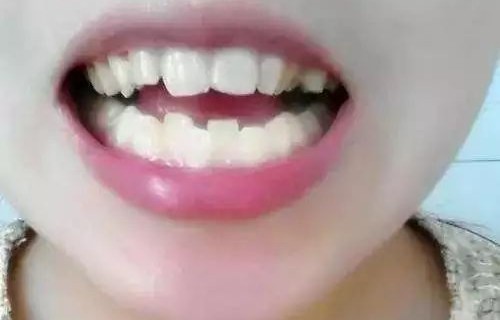 警惕过度精细喂养，6岁女童长出双排牙的警示