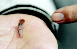 36岁女子意外发现胸部疙瘩，竟是乳腺癌的征兆