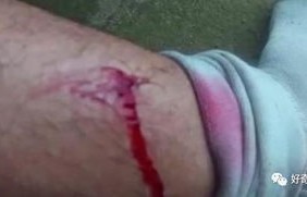 男生因女友咬伤手部疼痛难忍，紧急送医