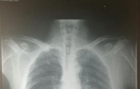 从正常到癌症，女子体检的惊变