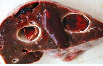 惊现七条虫，男子生食胆道之谜