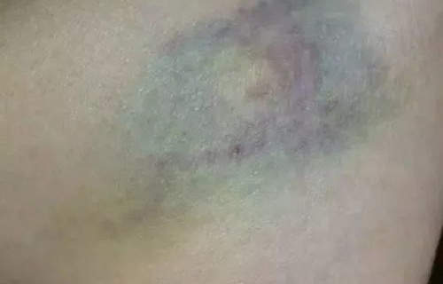 身体莫名淤青，原因与解析