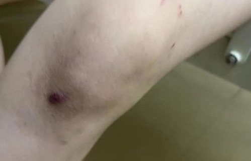 无人机意外事件，女子锁骨处被划破的背后