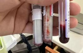 男子饭后突发剧痛,竟抽出牛奶血——健康警钟的背后