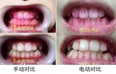医生为什么建议不用电动牙刷（医生为什么建议不用电动牙刷刷牙）