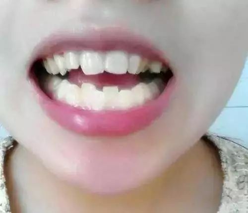 警惕过度精细喂养,6岁女童长出双排牙的警示 警惕过度精细喂养,6岁女童长出双排牙的警示