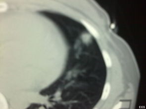 男子反复发热,肺中竟藏有颗牙齿——医学奇迹与罕见病例的探索 男子反复发热,肺中竟藏有颗牙齿——医学奇迹与罕见病例的探索